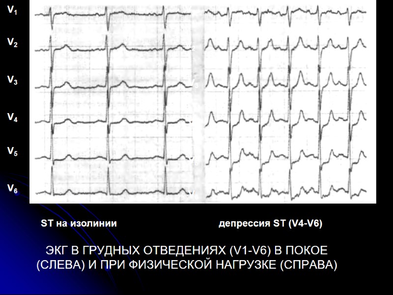 ЭКГ В ГРУДНЫХ ОТВЕДЕНИЯХ (V1-V6) В ПОКОЕ (СЛЕВА) И ПРИ ФИЗИЧЕСКОЙ НАГРУЗКЕ (СПРАВА) V1